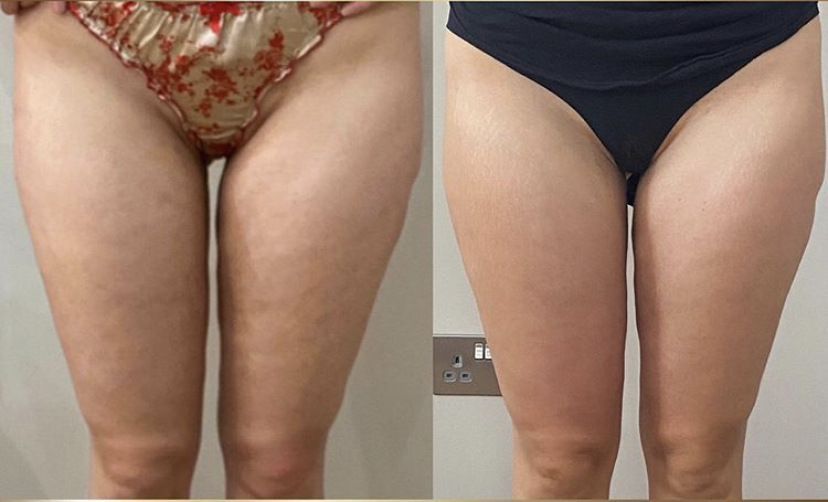 Nu Skin ageLO Dermatic Effect Cellulite Cream Price