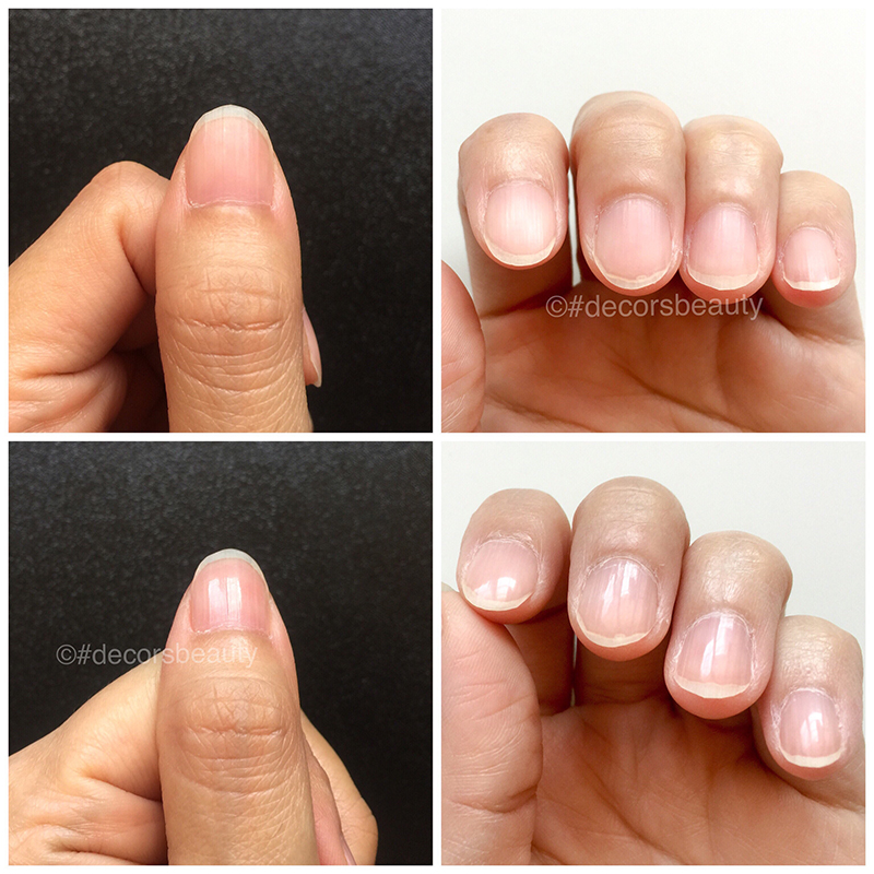 Dr. Dana Nail Renewal System Testimonial - Before and After One Treatment